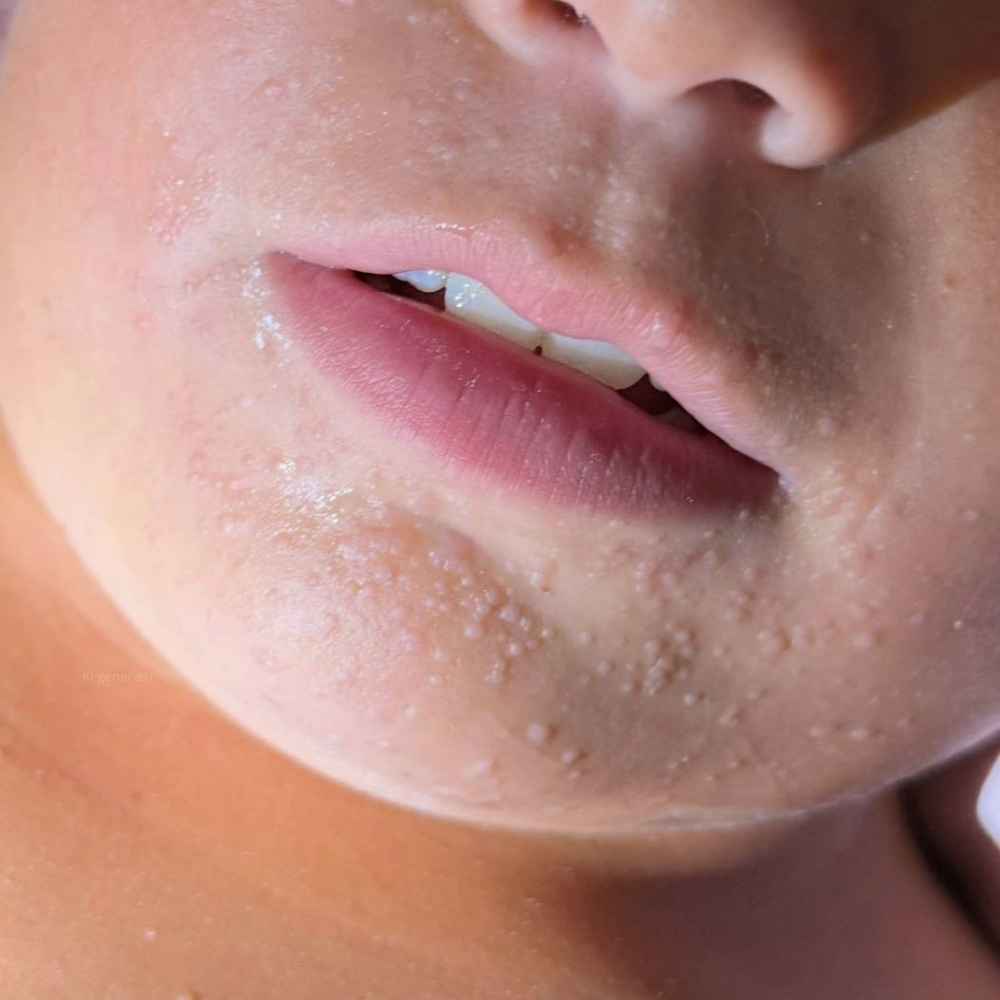 Massive Flachwarzen im Gesicht, achtjähriger Junge.